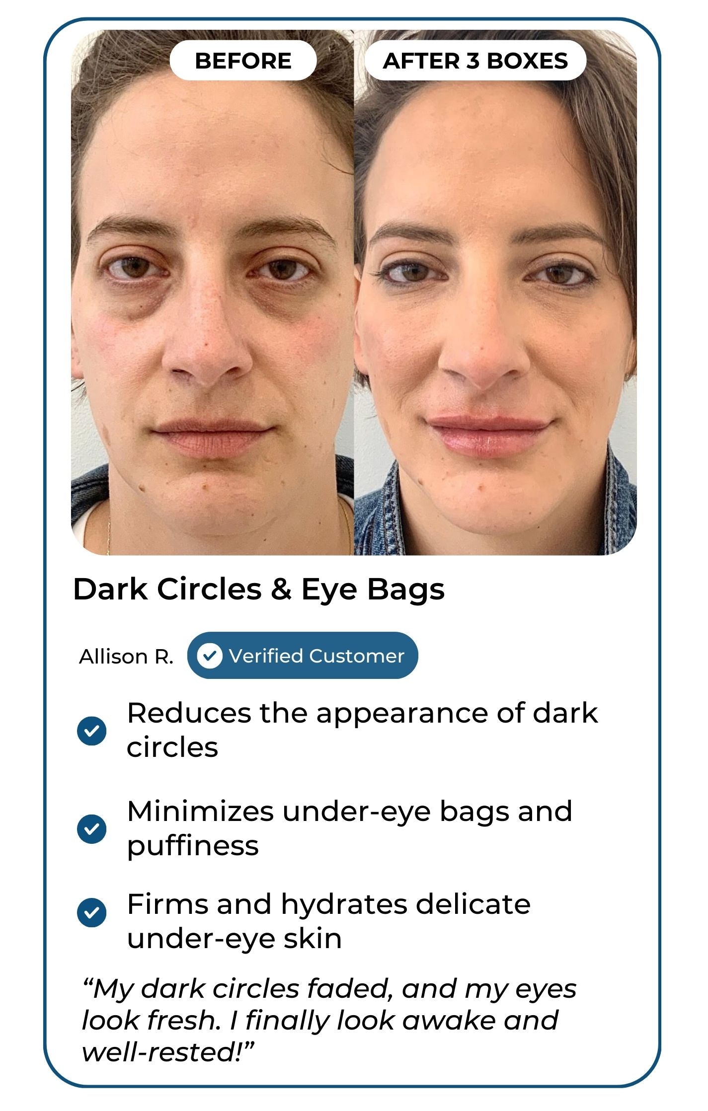 Dark circles and eye bags customer results