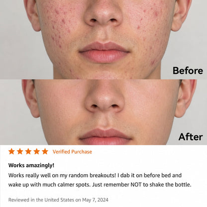 Korean 3H Overnight Drying Lotion- Targeted Spot Care for Troubled & Oily-Prone Skin