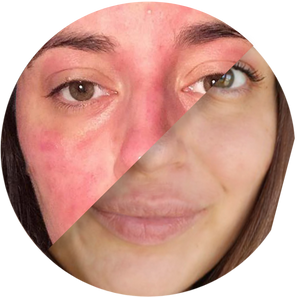 AD-COMPOSITE-Miracle-Eczema-Cream-V2_1.png