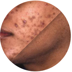 Hyperpigmentation_before_and_after.png